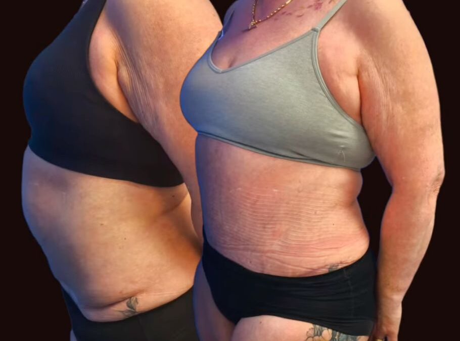 Third Time Lucky: A Complex Tummy Tuck Revision Story with a Happy Ending