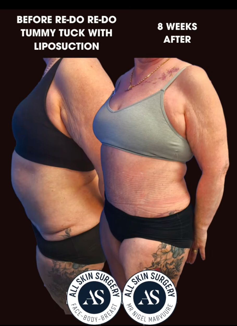 A Complex Tummy Tuck Revision Story with a Happy Ending