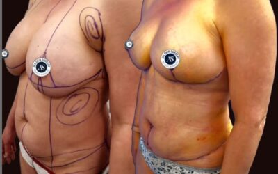 Healing Progress After Mummy Makeover: What to Expect at 2 Weeks