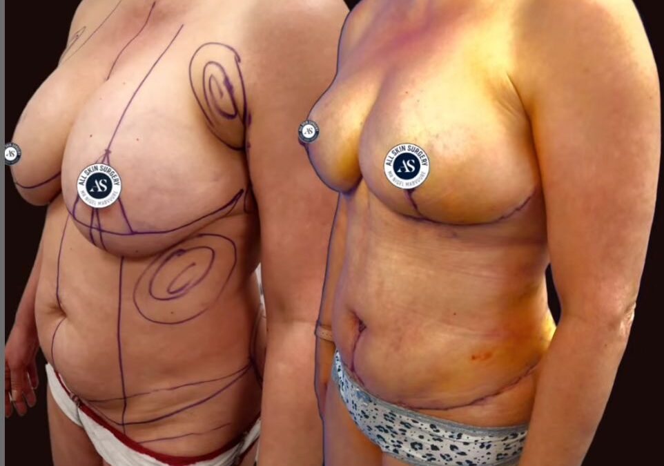Healing Progress After Mummy Makeover: What to Expect at 2 Weeks