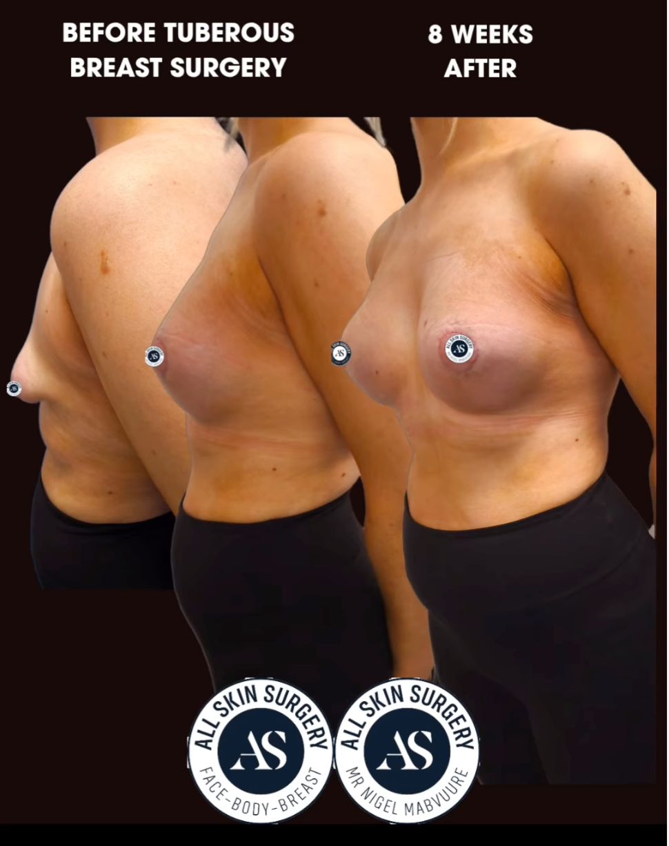 tuberous breast surgery before after 8 weeks