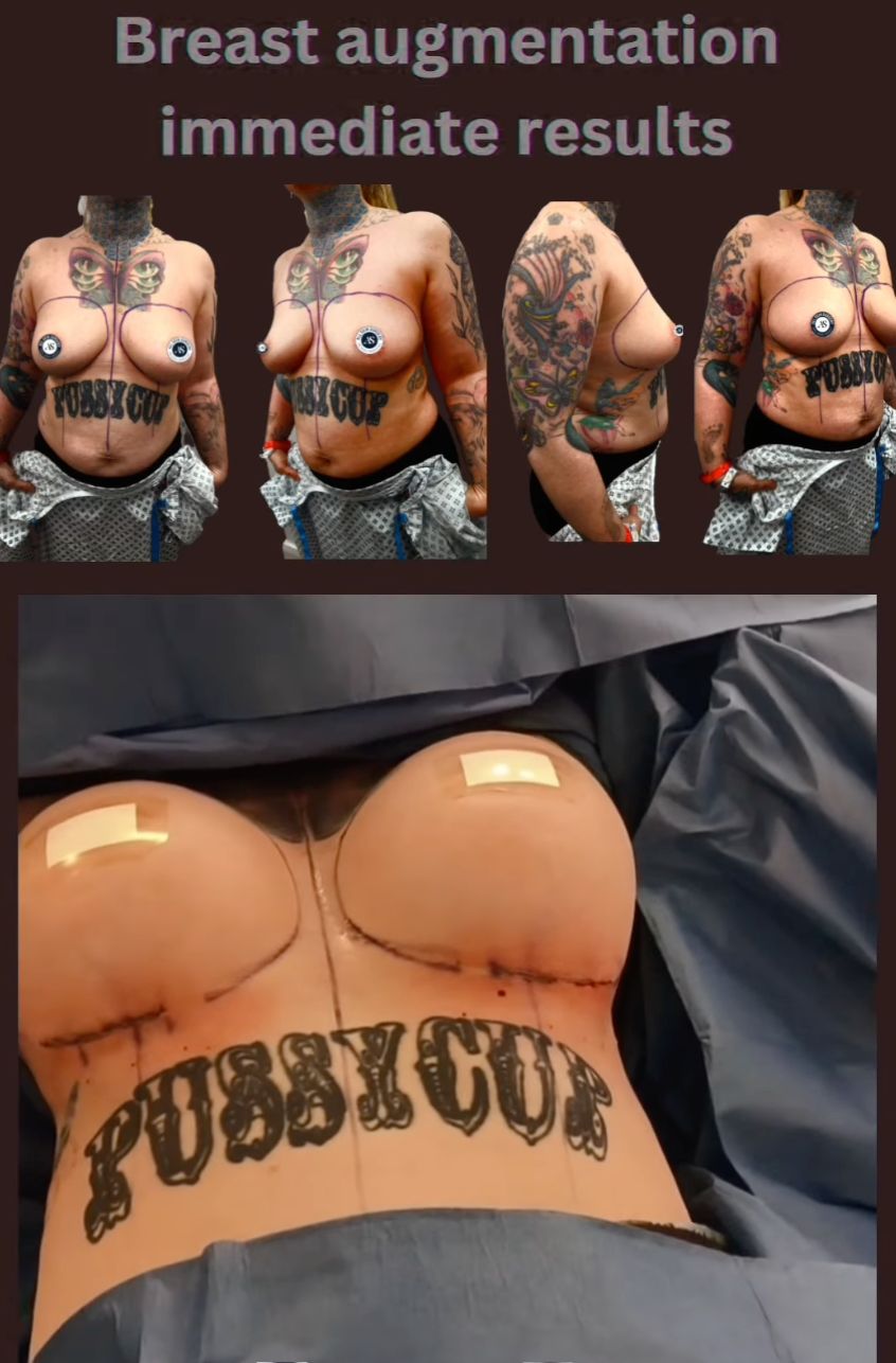 550cc Breast Implants for the Right Patient