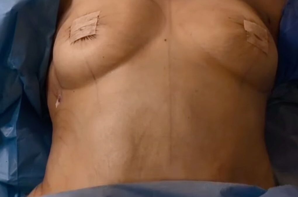 Mummy Makeover Magic: Natural Enhancement Without Implants