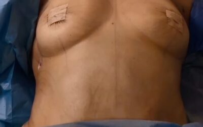 Mummy Makeover Magic: Natural Enhancement Without Implants