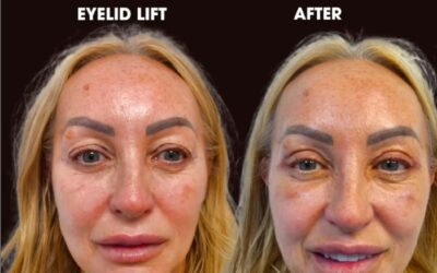 Upper Eyelid Rejuvenation: Subtle, Effective, and Life-Enhancing