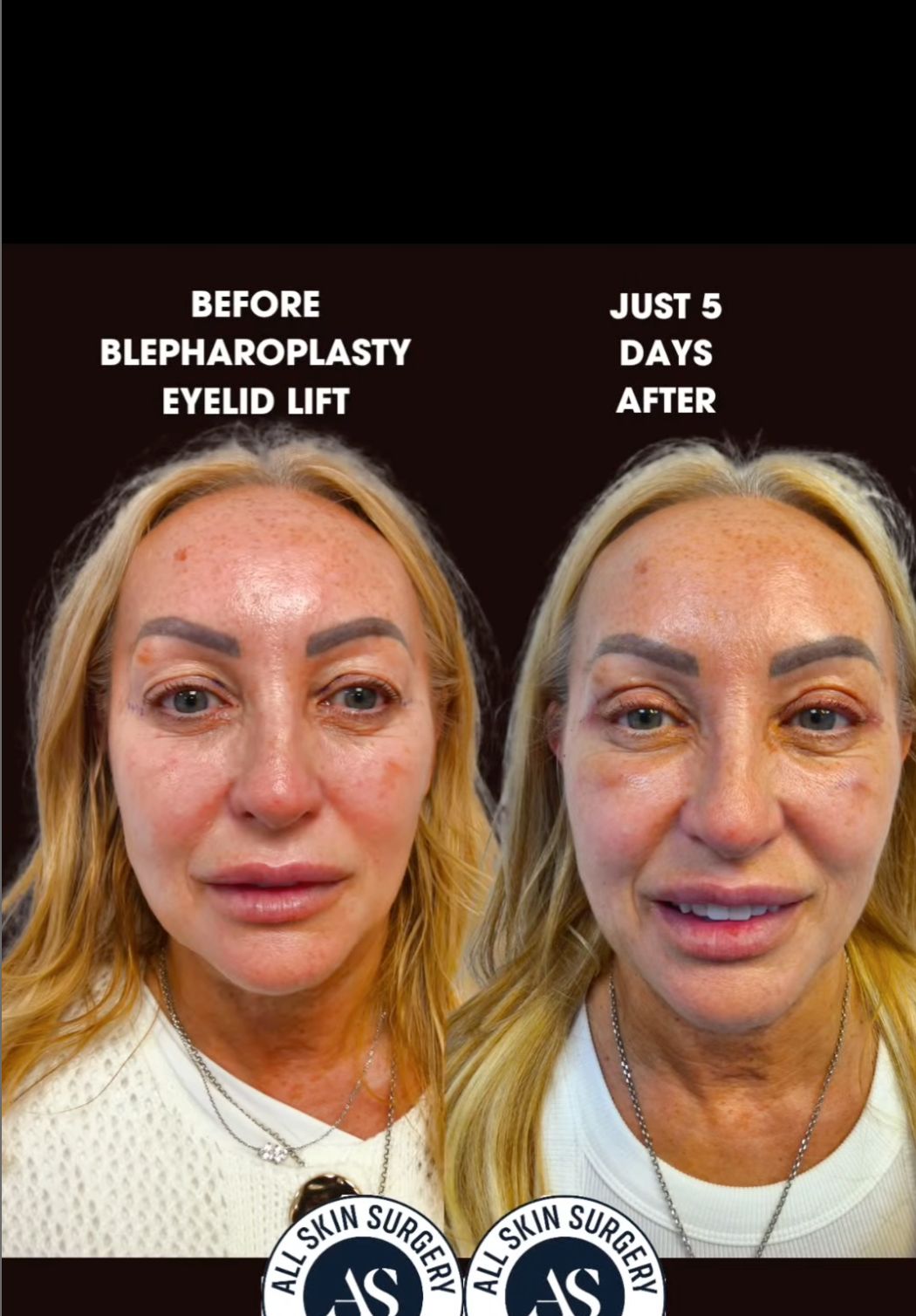 Upper Eyelid Rejuvenation