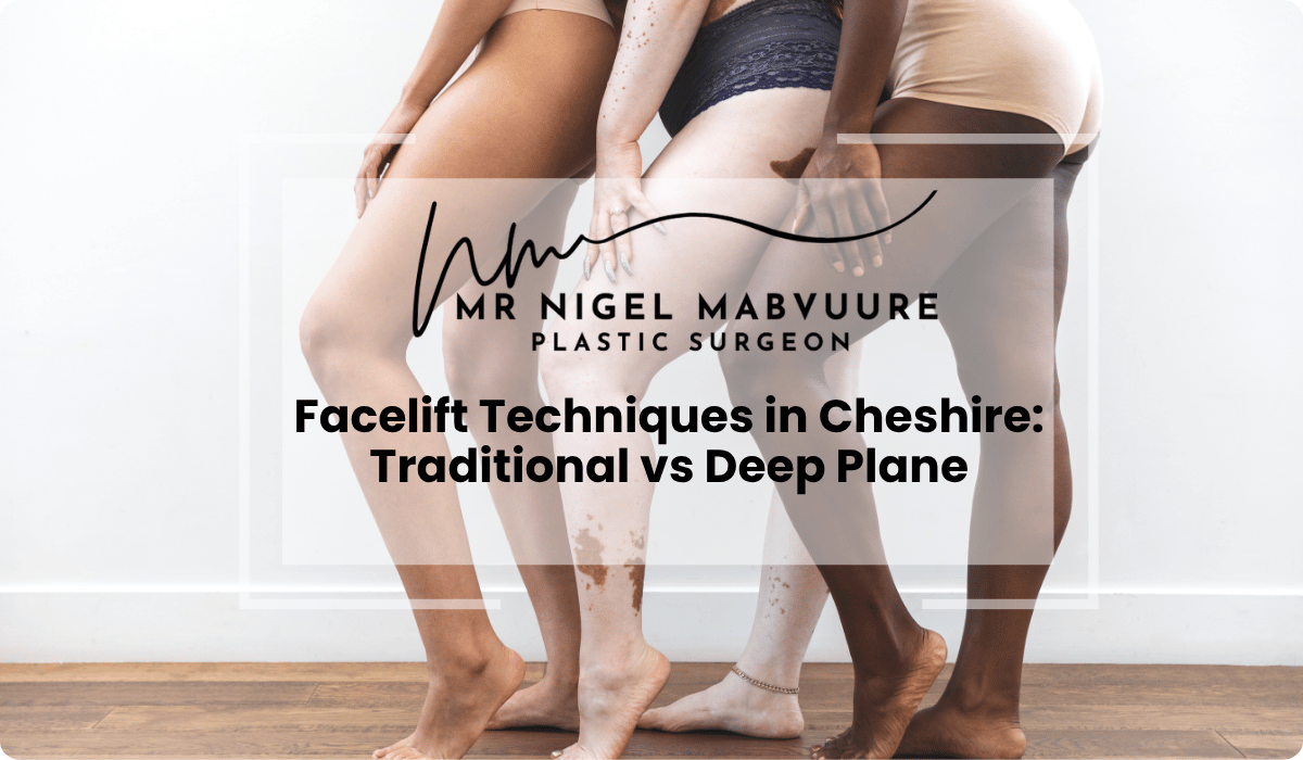 facelift techniques cheshire traditional vs deep plane