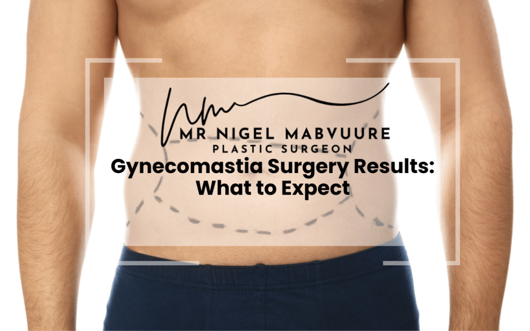 What to Expect After Gynecomastia Surgery: Results, Recovery and Reality